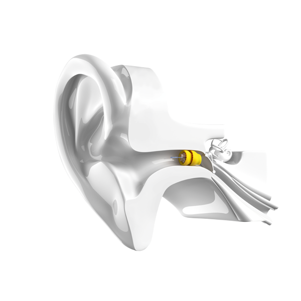 Anatomic view of the inside of human ear with Phonak Lyric hearing aid fitted deep inside outer ear canal.